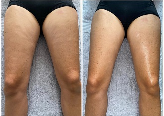 Une photo avant/après de résultats après la séance de massage des jambes